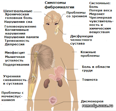 Симптомы фибромиалгии